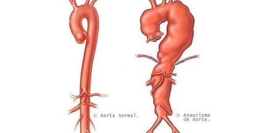 Reconstrução em Tomografia de Aneurisma de Aorta