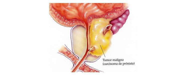 cintilografia Óssea metastase - Tumor Maligno