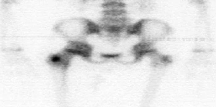 cintilografia óssea radiologia