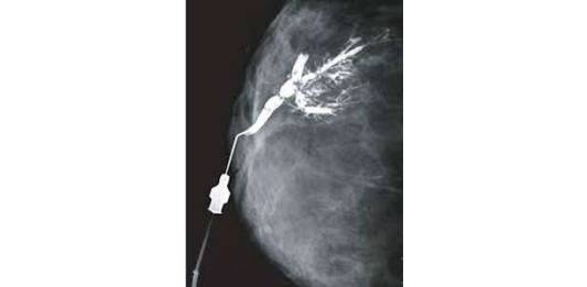 Mamografia com Contraste. Conheça o Exame de Galactografia