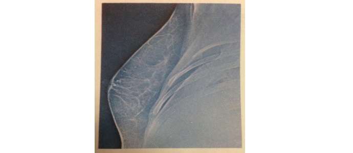 mamografia contraste