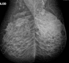 Mamografia Normal, Entenda o Resultado do Exame de Mamografia