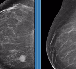 Mamografia. Conheça os Posicionamentos Básicos