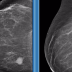 Mamografia. Conheça os Posicionamentos Básicos