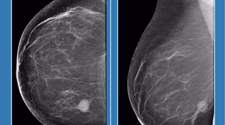mamografia posicionamento