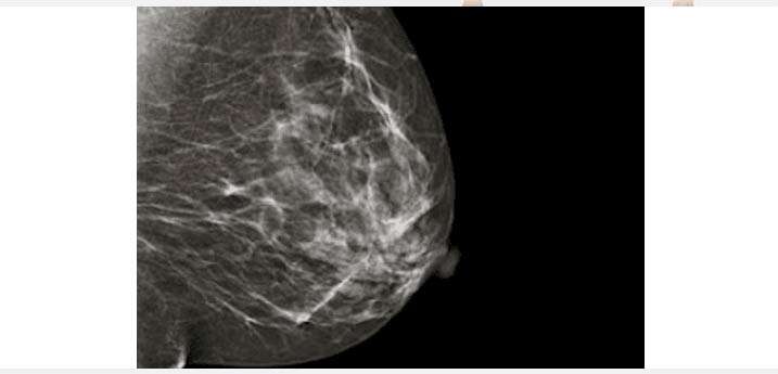Imagem de uma mamografia