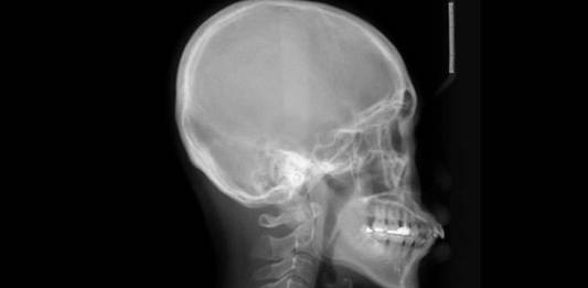 Saiba Mais Sobre o Posicionamento Radiológico do Crânio