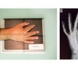 Incidências Oblíquas das Mãos para Avaliar Alterações Ósseas Degenerativas