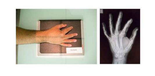 Incidências Oblíquas das Mãos para Avaliar Alterações Ósseas Degenerativas