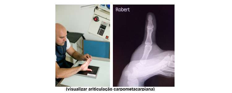 posicionamento radiológico - polegar (método de Robert)