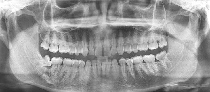 radiologia odontológica periapical