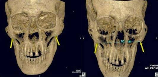 03 Reconstruções de Tomografia 3D do Crânio Incríveis