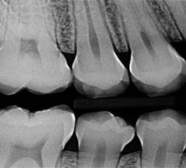 Radiologia Odontológica, Saiba Mais Sobre as Técnicas Intrabucais