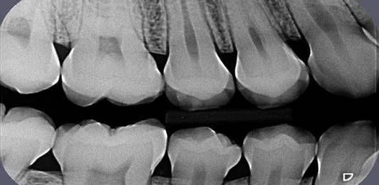Radiologia Odontológica, Saiba Mais Sobre as Técnicas Intrabucais