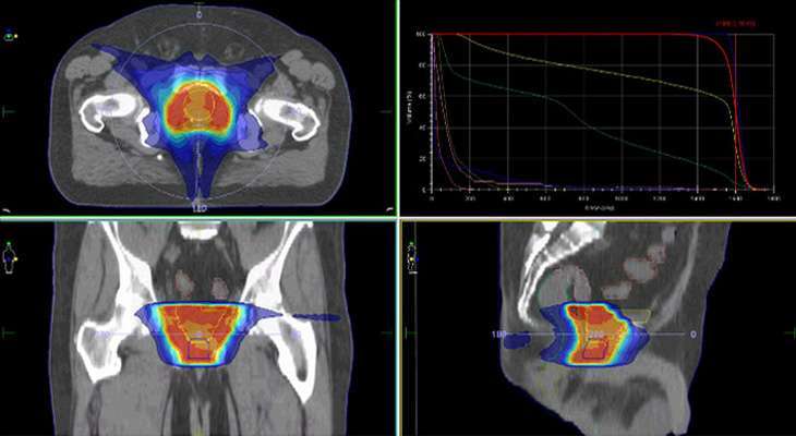 radioterapia câncer de próstata