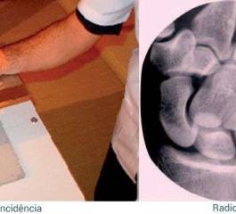 Posicionamentos Radiológicos Para Visualizar Pequenas Lesões Ósseas