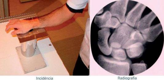 Posicionamentos Radiológicos Para Visualizar Pequenas Lesões Ósseas