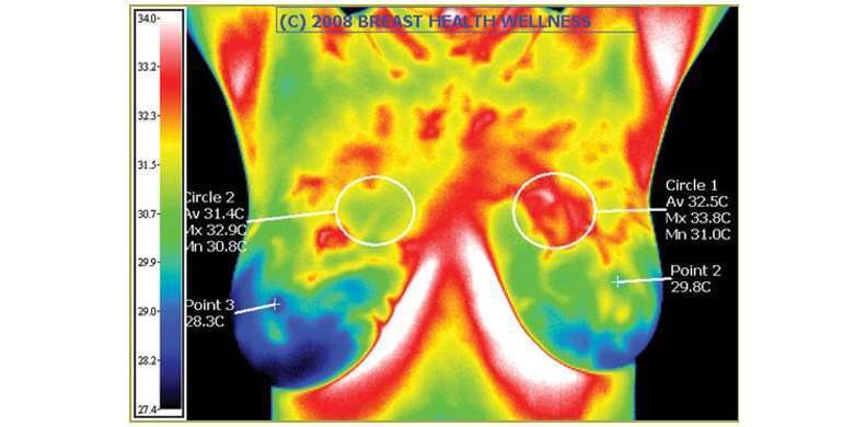 termografia radiologia mama