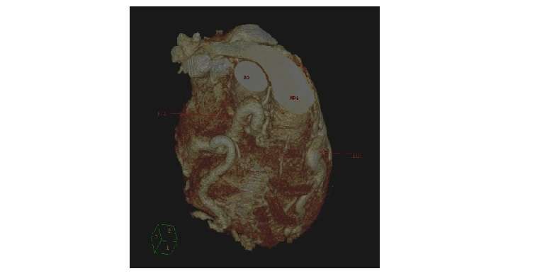 tomografia computadorizada cardíaca