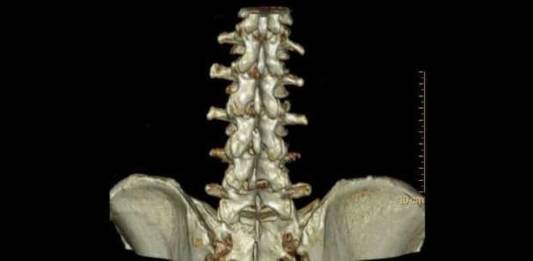 Tomografia computadorizada da coluna vertebral, saiba mais