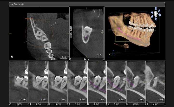 tomografia odontológica