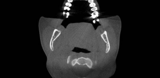 A Importância da Tomografia Cone Beam na Radiologia Odontológica
