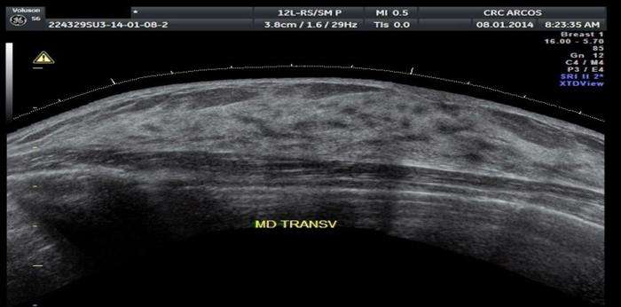 ultrassom da mama radiologia